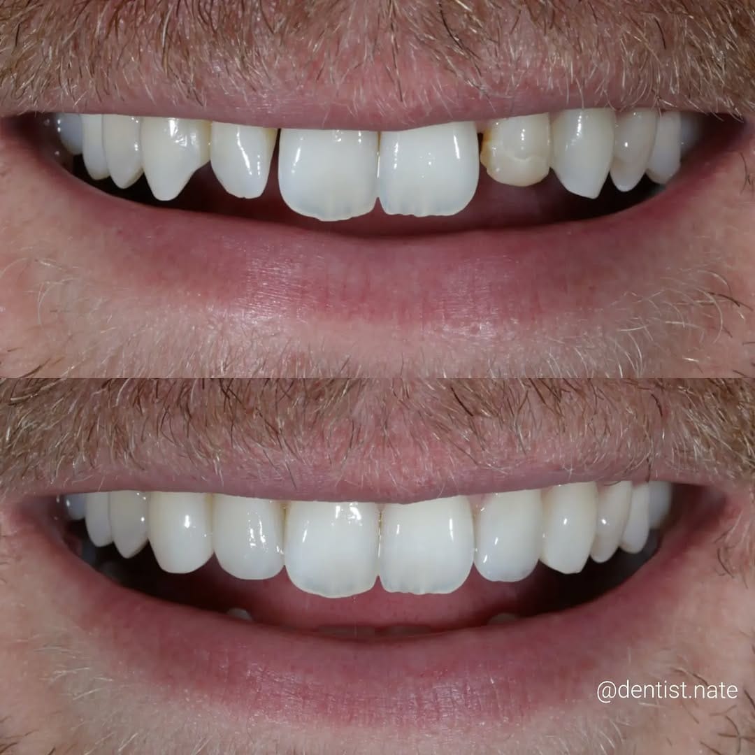 Post 7 by Composite bonding | Veneers on Instagram (image)