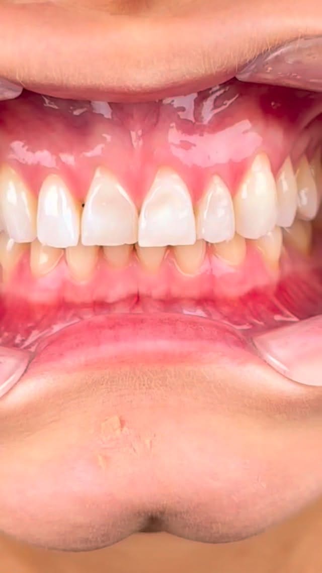Post 2 by Jack Livesey BDS PGDip on Instagram (video)