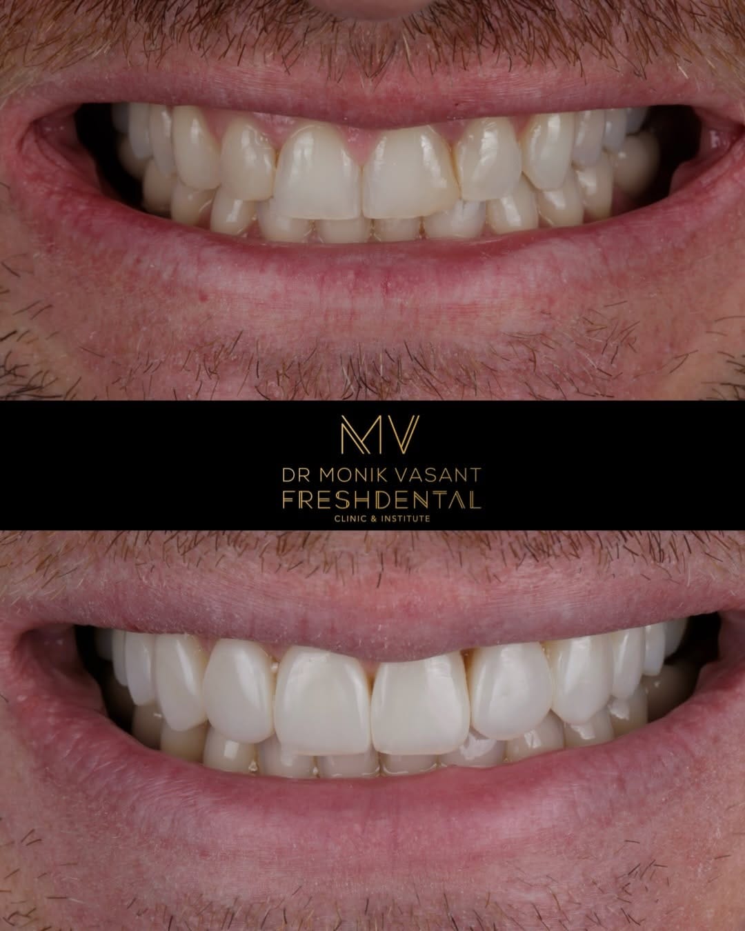 Post 7 by Dr Monik Vasant | Cosmetic Dentist London on Instagram (carousel)