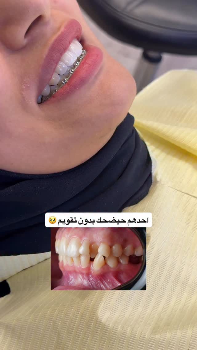 Post 6 by دكتور حيدر علاء / تقويم وزراعة الاسنان on Instagram (video)