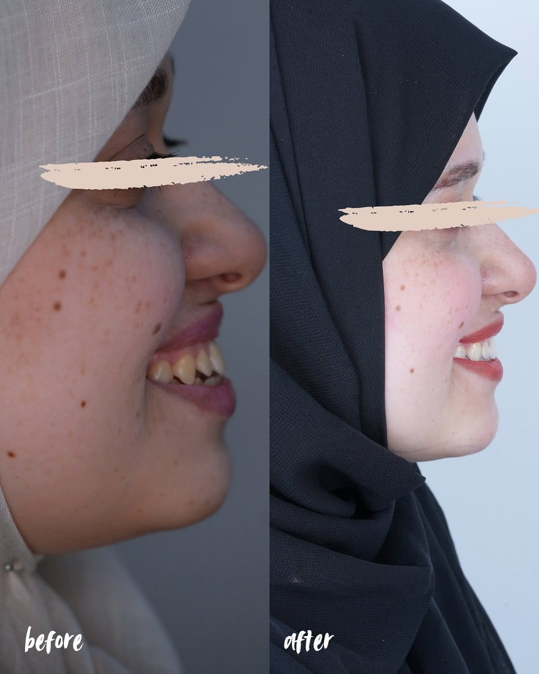 Post 10 by دكتور حيدر علاء / تقويم وزراعة الاسنان on Instagram (carousel)