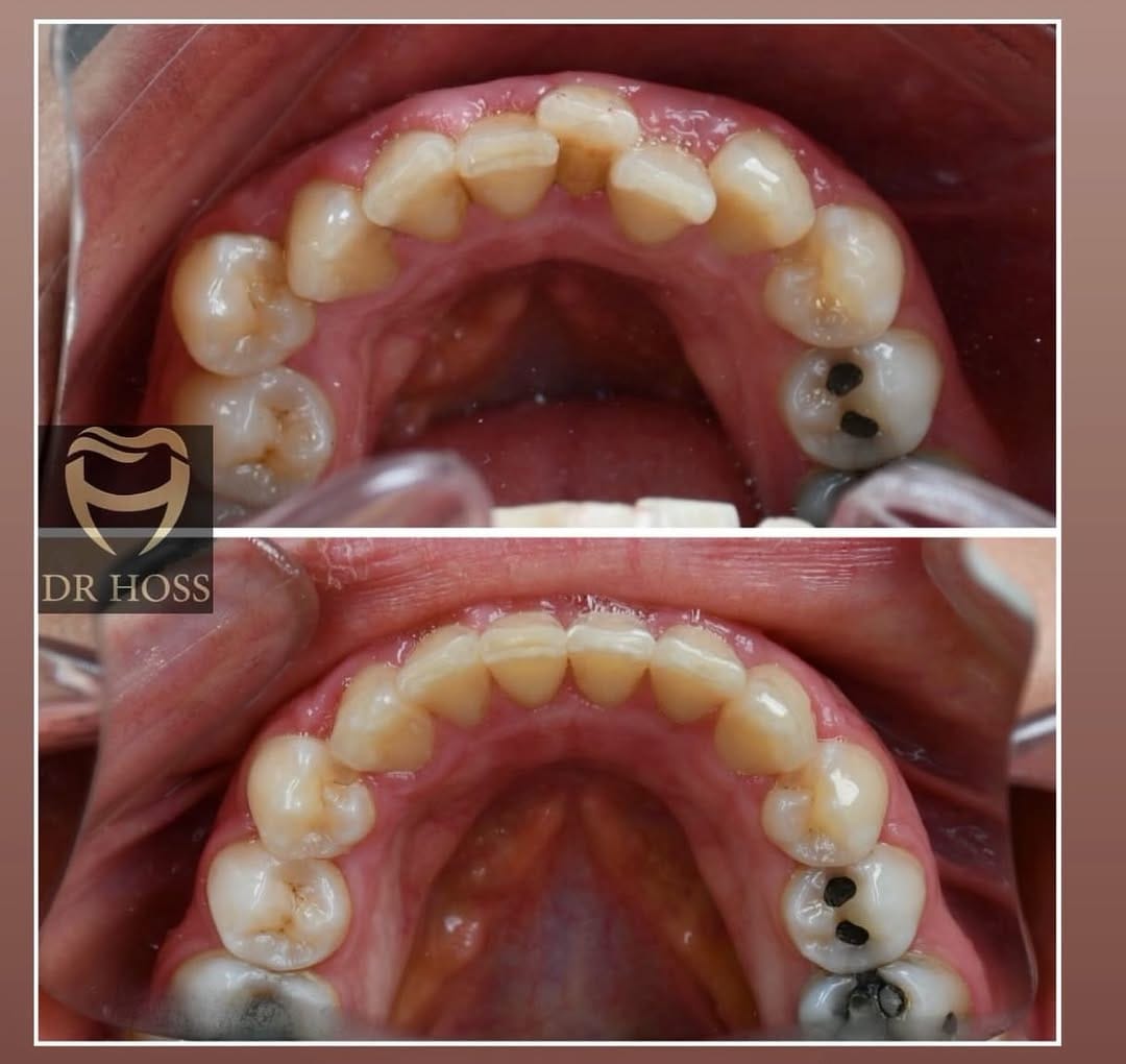 Post 4 by ارتودنسی شفاف🦷الاینرهای شفاف🦷الاینر شفاف🦷کامپوزیت و سرامیک ونیر on Instagram (carousel)