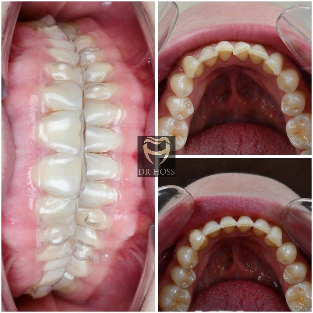 Post 6 by ارتودنسی شفاف🦷الاینرهای شفاف🦷الاینر شفاف🦷کامپوزیت و سرامیک ونیر on Instagram (carousel)