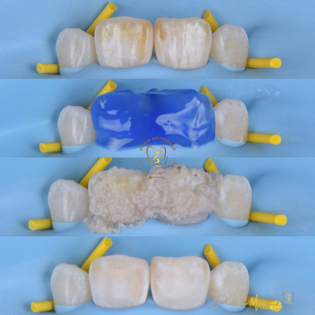 Post 5 by Dr Umair Mohammed | Cosmetic & Sports Dentist | 📍 Edinburgh on Instagram (image)