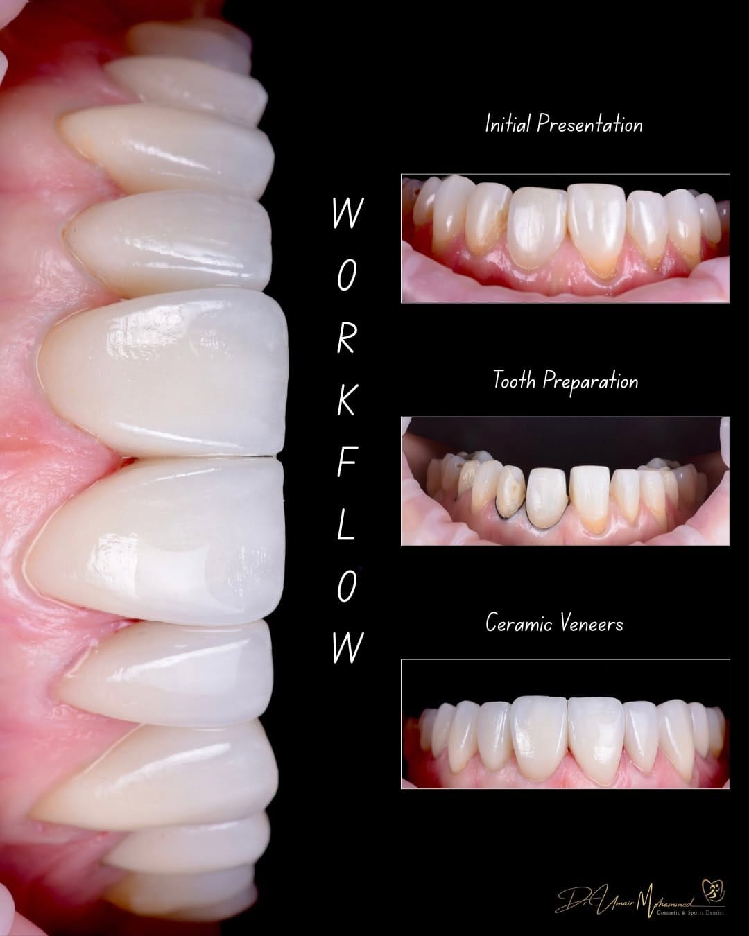 Post 1 by Dr Umair Mohammed | Cosmetic & Sports Dentist | 📍 Edinburgh on Instagram (carousel)