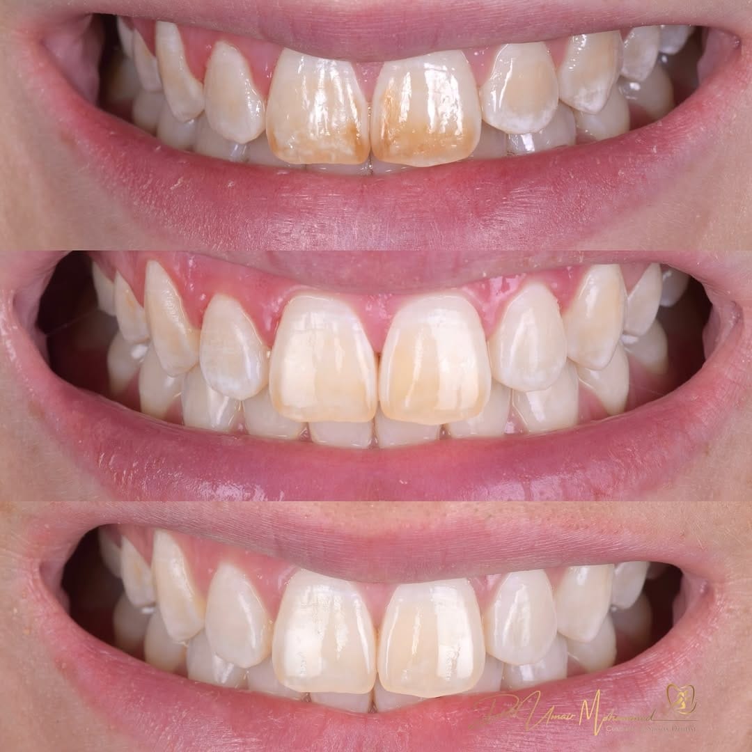 Post 3 by Dr Umair Mohammed | Cosmetic & Sports Dentist | 📍 Edinburgh on Instagram (carousel)