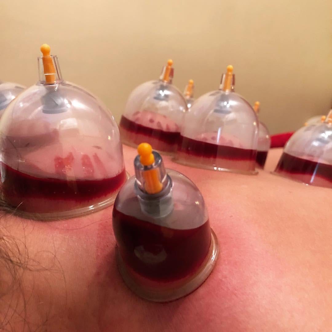 Post 6 by CuppingTherapyLiverpool on Instagram (carousel)