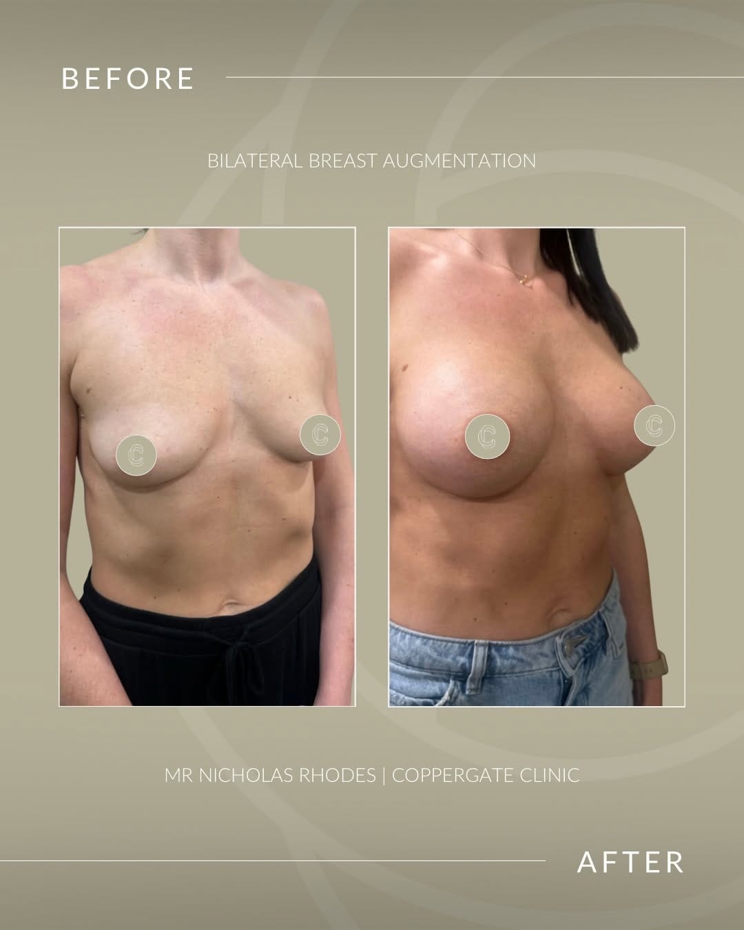 Post 1 by Coppergate Clinic | Cosmetic Surgery on Instagram (carousel)