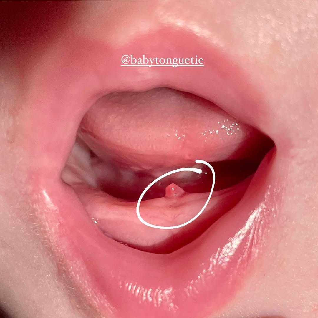 Post 5 by Samantha Tanak •Tongue Tie Specialist Midwife on Instagram (image)