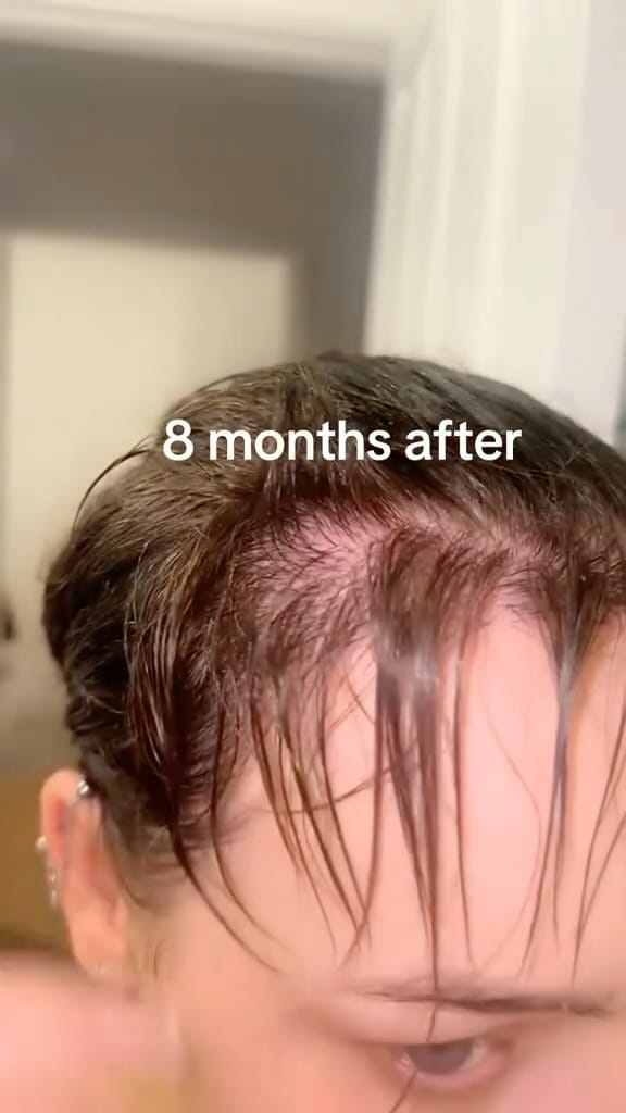 Post 2 by KSL Clinic | Hair Transplant on Instagram (video)