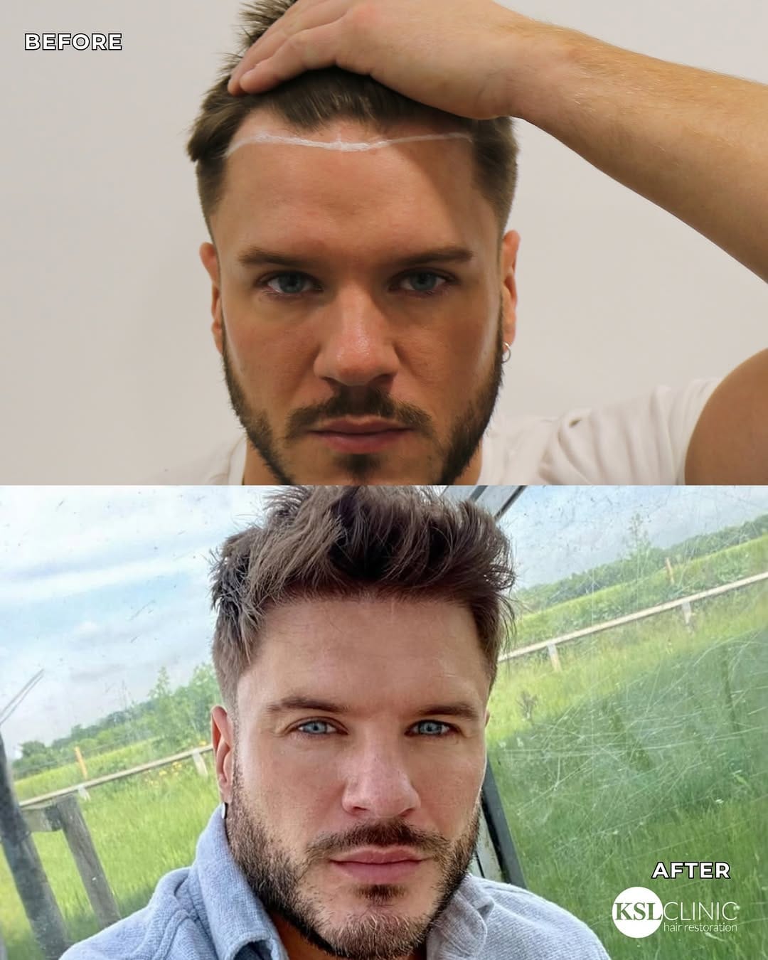Post 1 by KSL Clinic | Hair Transplant on Instagram (image)