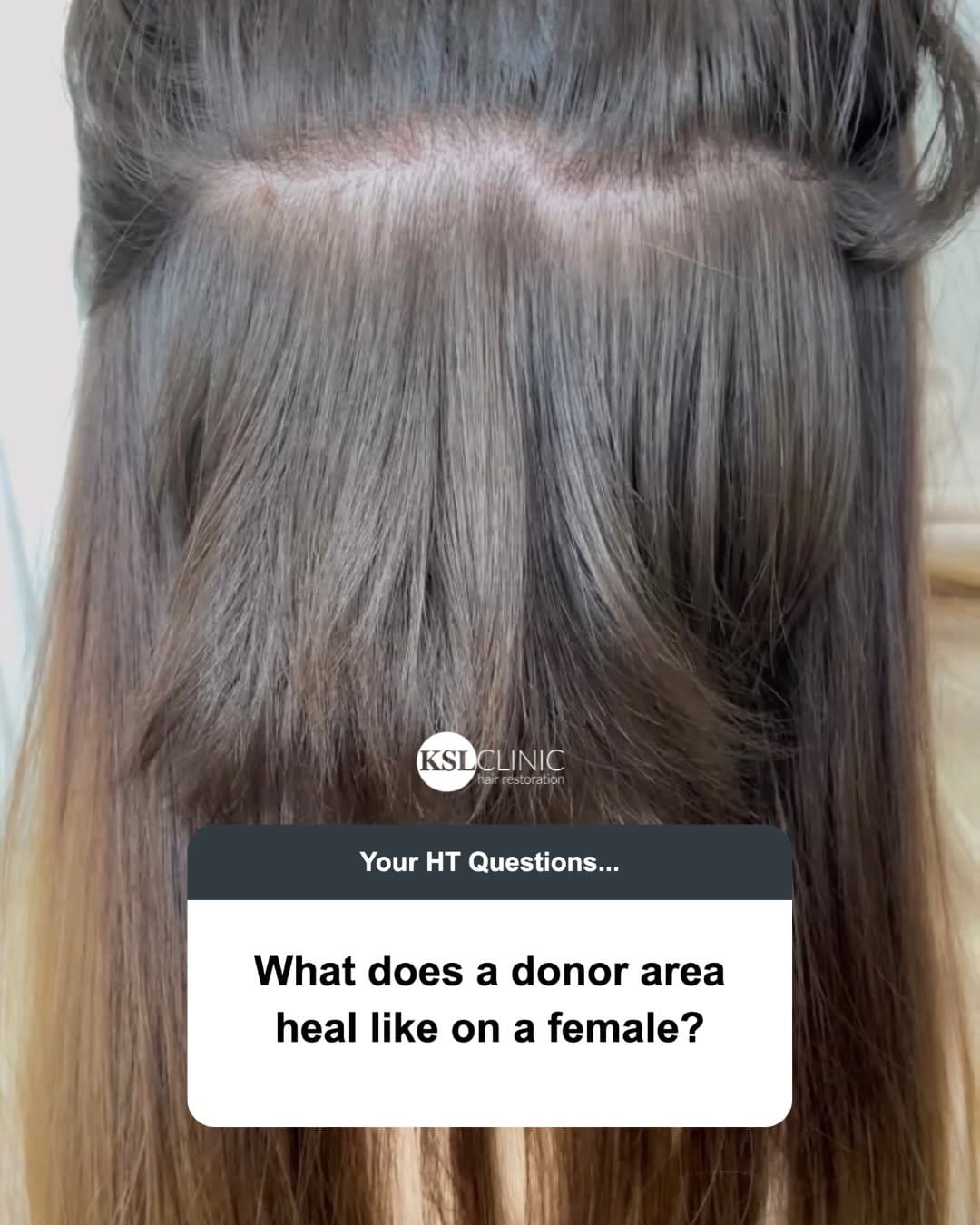 Post 6 by KSL Clinic | Hair Transplant on Instagram (carousel)