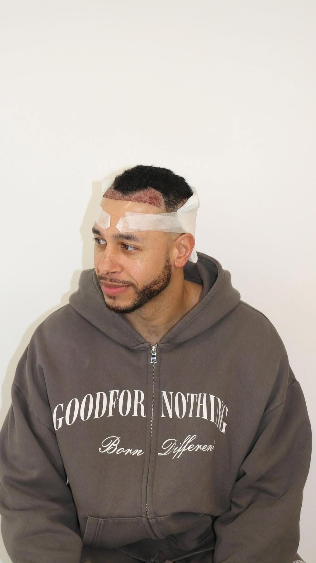 Post 10 by KSL Clinic | Hair Transplant on Instagram (video)