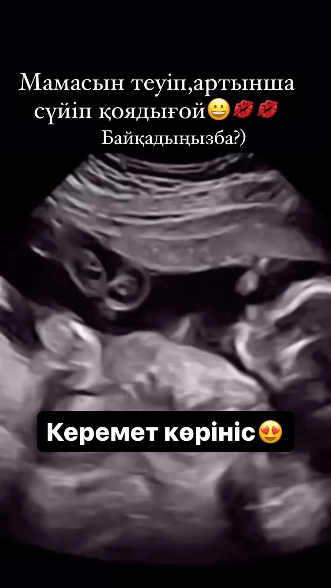Post 9 by ЭКО в Шымкенте •  РЕПРОДУКТОЛОГ •  ГИНЕКОЛОГ on Instagram (video)