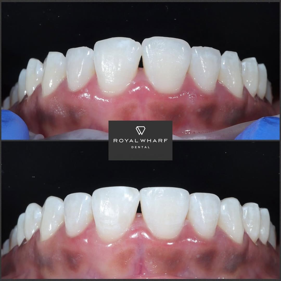 Post 2 by Royal Wharf Dental on Instagram (image)