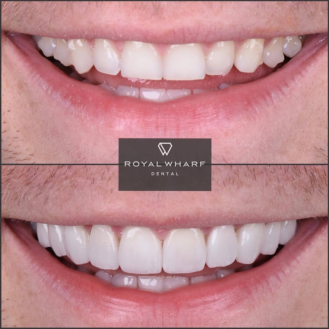 Post 5 by Royal Wharf Dental on Instagram (image)