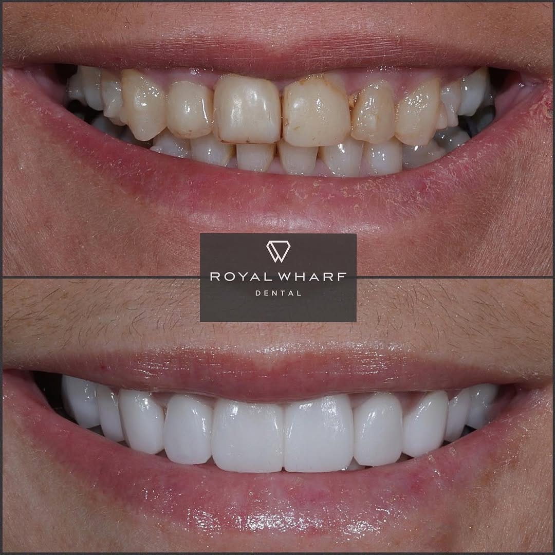 Post 10 by Royal Wharf Dental on Instagram (image)