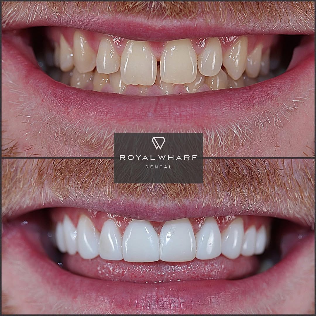 Post 7 by Royal Wharf Dental on Instagram (image)