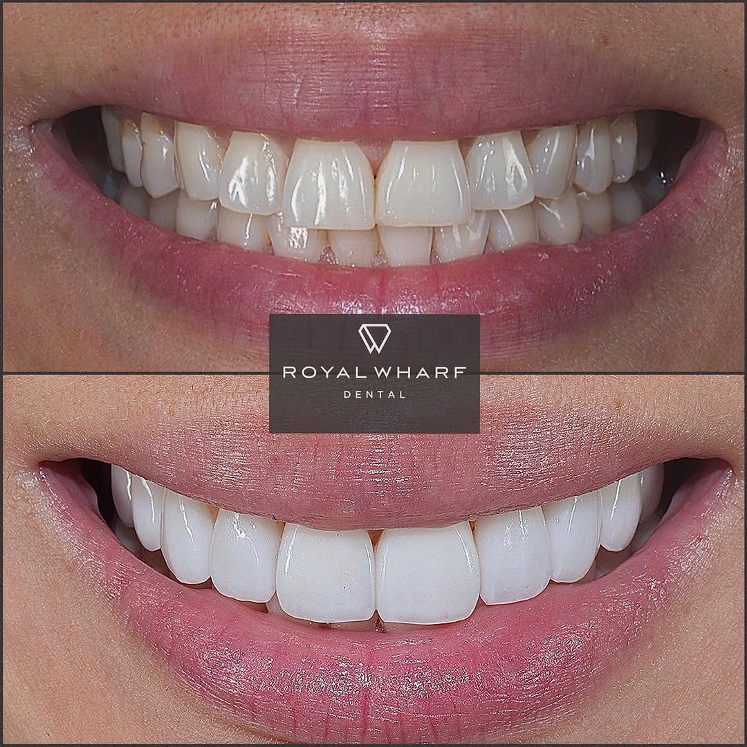 Post 8 by Royal Wharf Dental on Instagram (image)