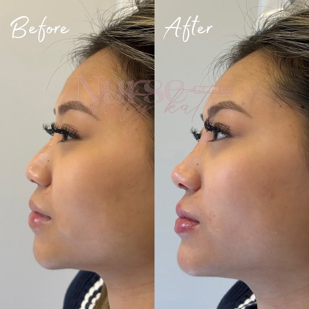 Post 10 by Nurse Prescriber Kat BSc INP | Medical Aesthetics London on Instagram (carousel)