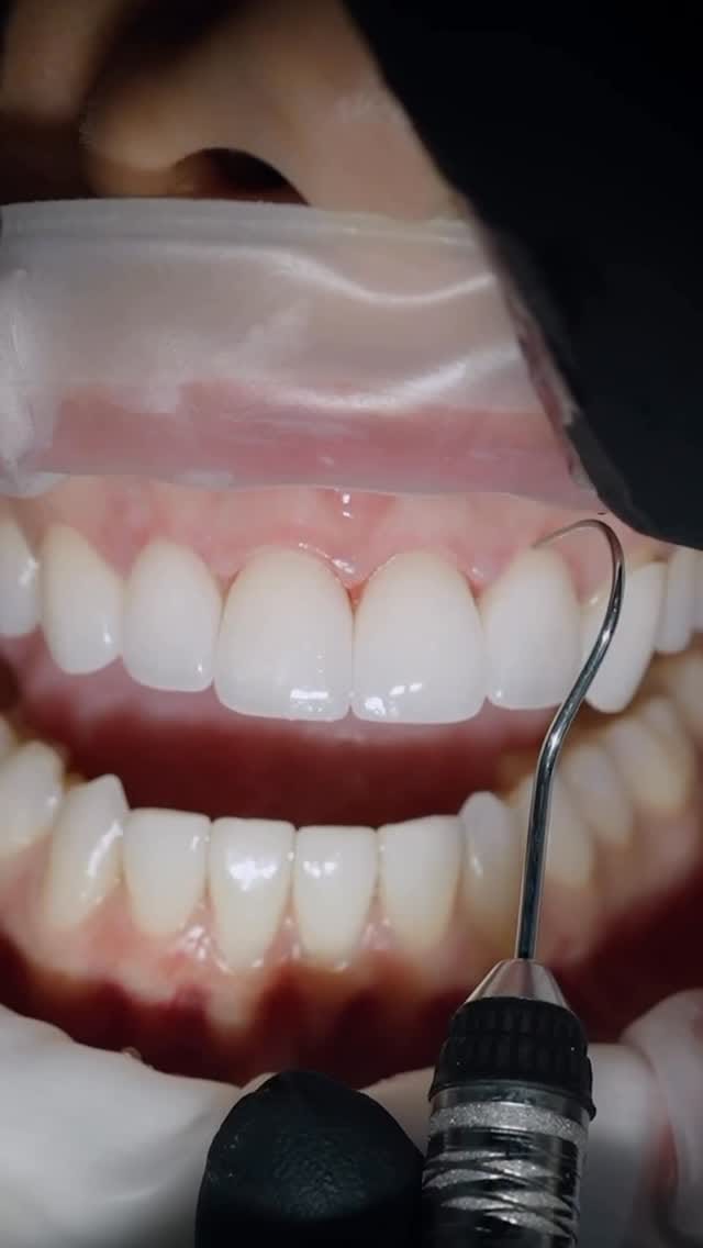Post 4 by Ultradent dental clinic🦷 on Instagram (video)