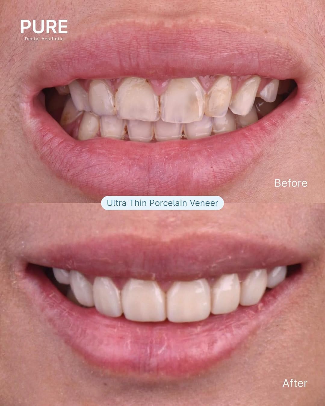 Post 3 by #1 Veneer Dental Clinic on Instagram (carousel)