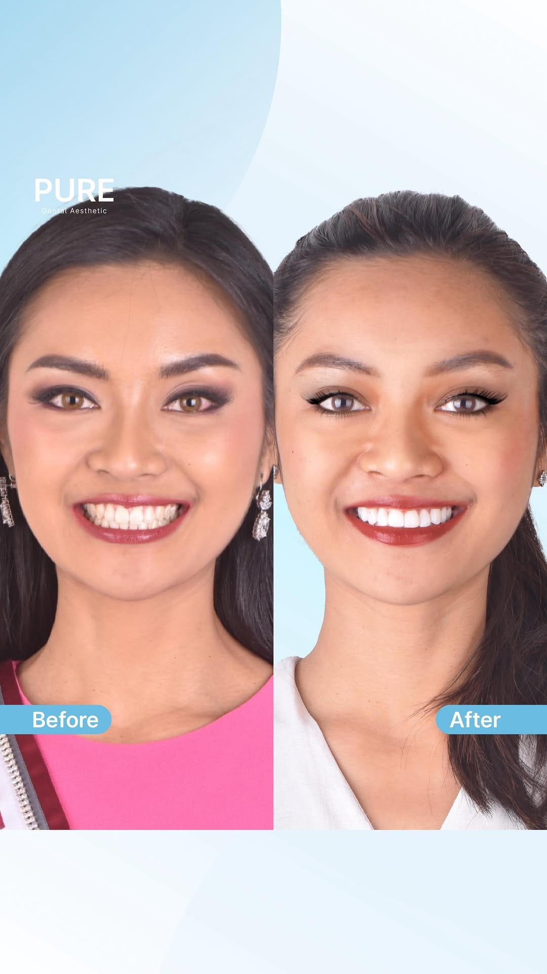 Post 1 by #1 Veneer Dental Clinic on Instagram (video)