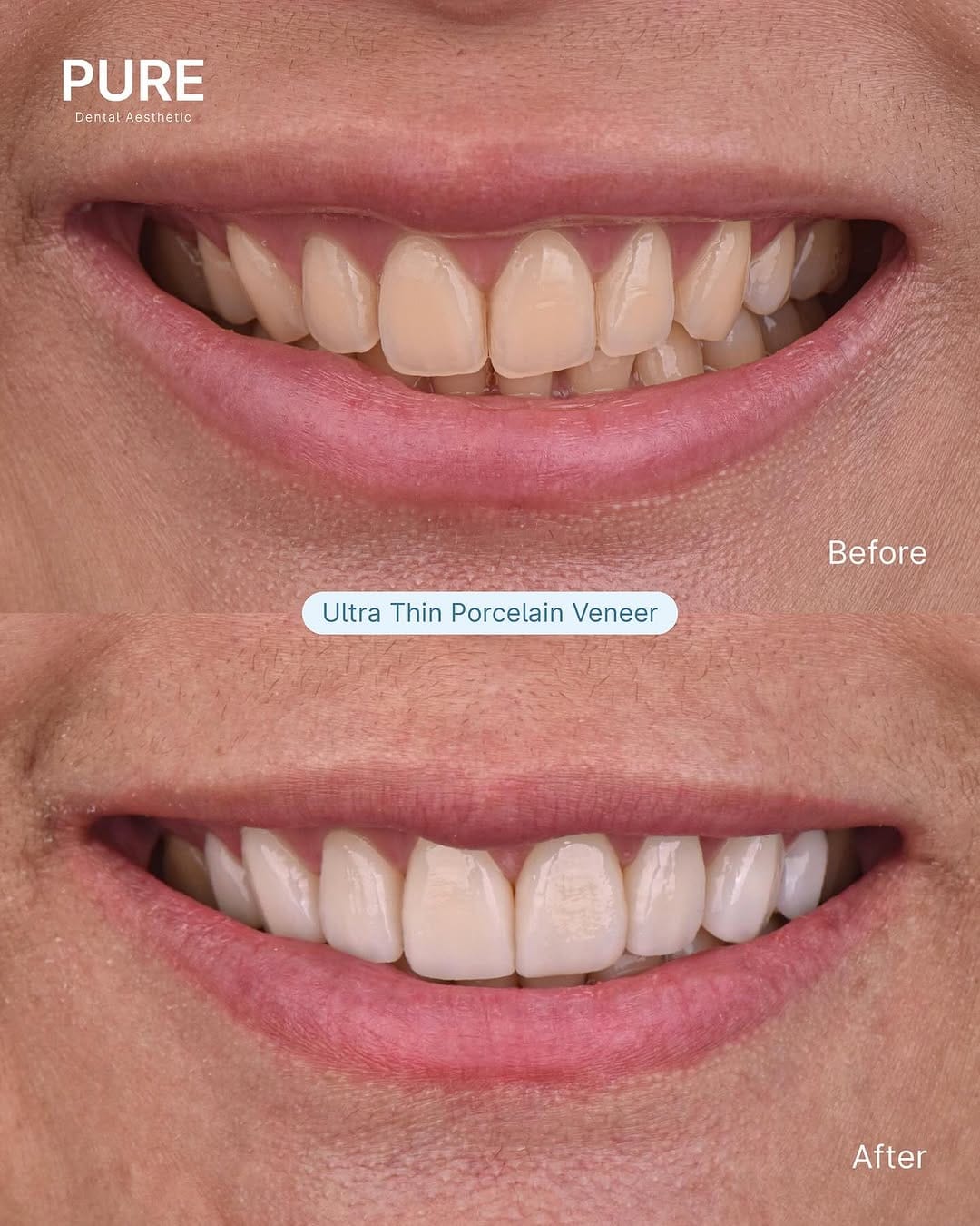 Post 6 by #1 Veneer Dental Clinic on Instagram (carousel)