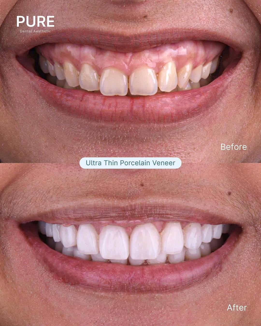 Post 9 by #1 Veneer Dental Clinic on Instagram (carousel)
