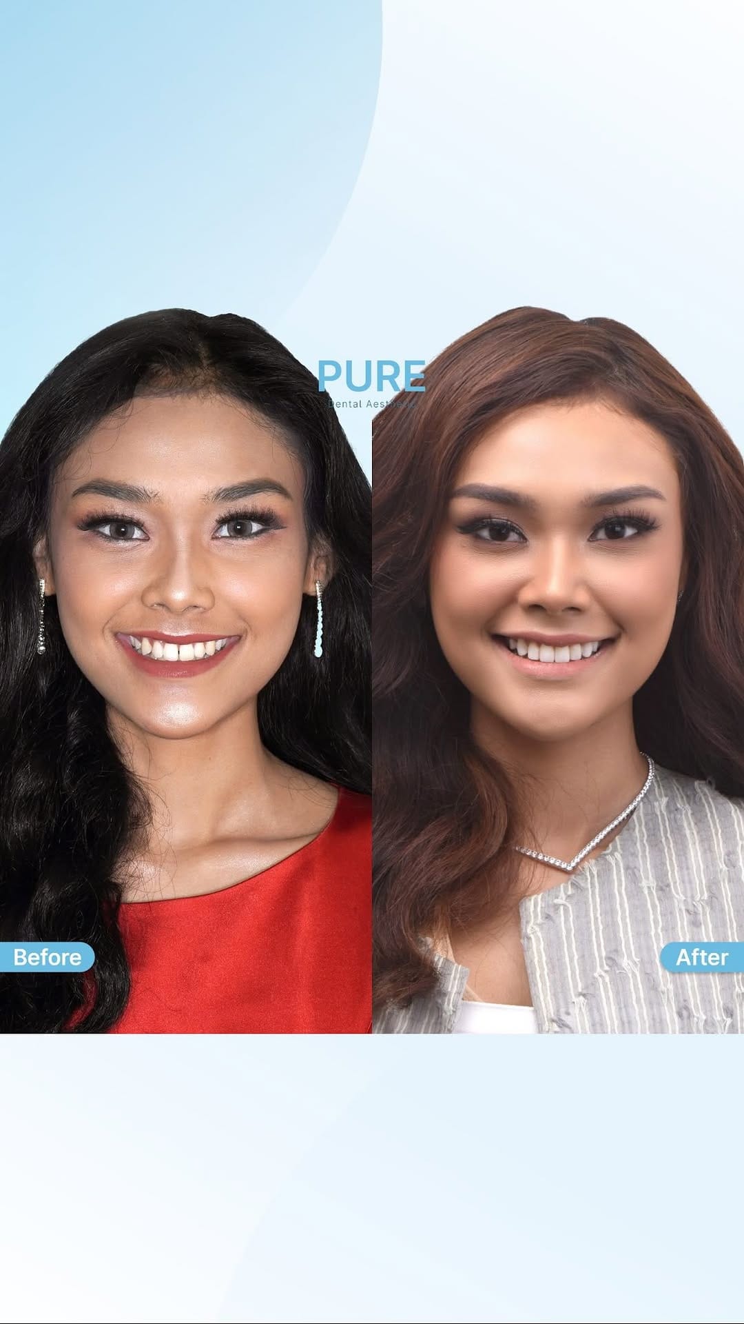 Post 7 by #1 Veneer Dental Clinic on Instagram (video)
