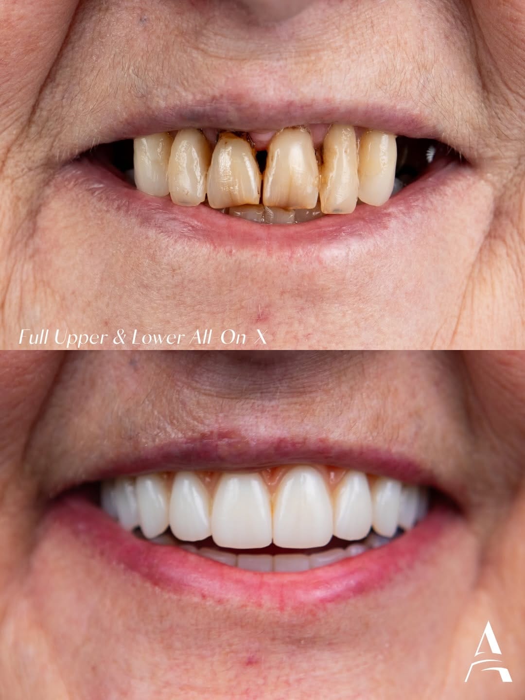 Post 1 by Nova Dental Implant Centre 😁 on Instagram (carousel)