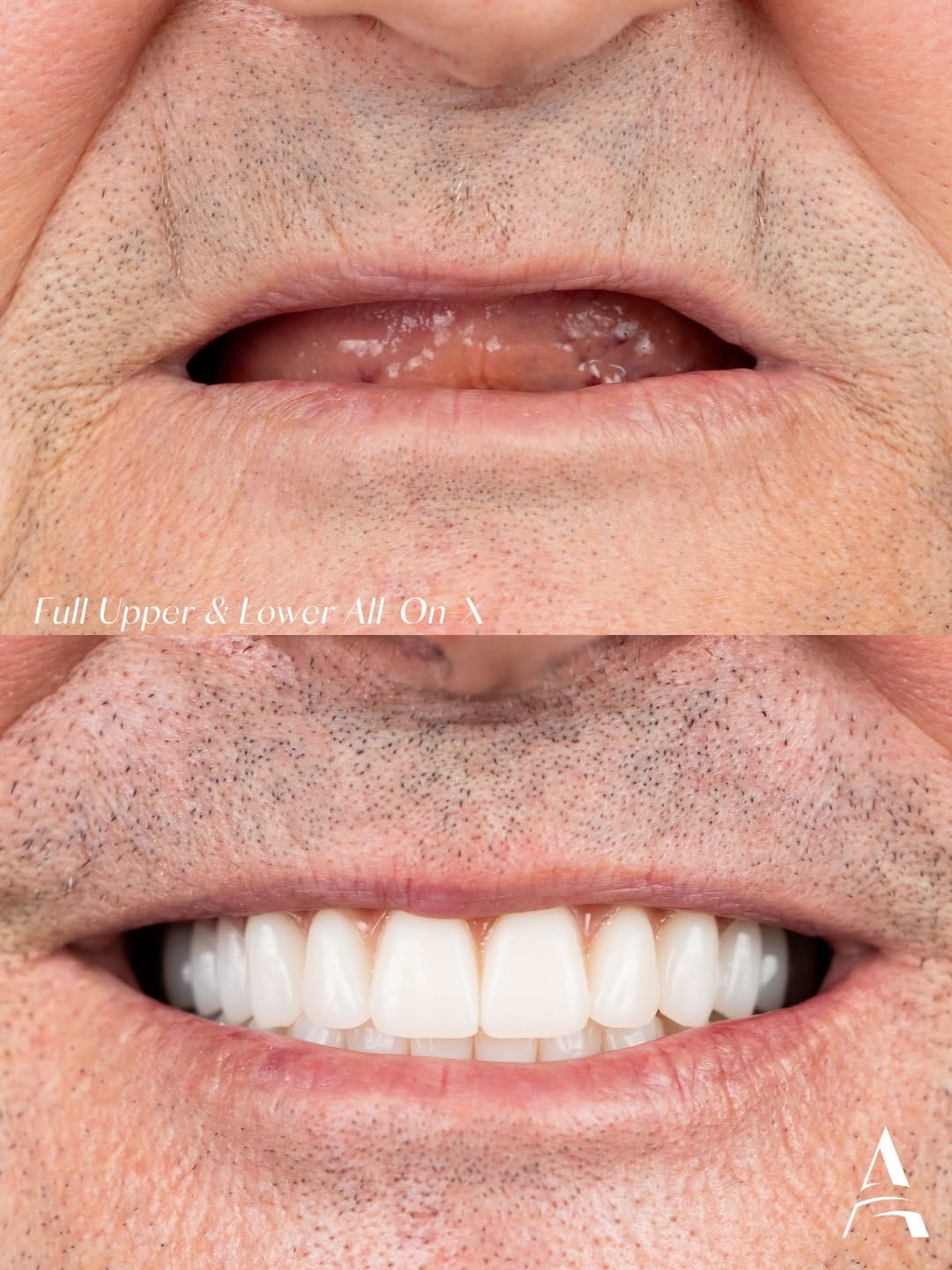 Post 7 by Nova Dental Implant Centre 😁 on Instagram (carousel)