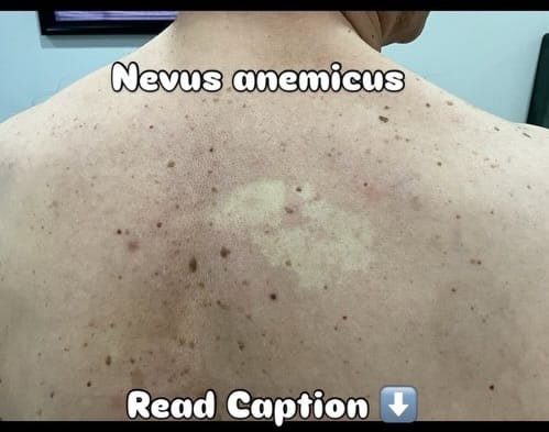 Post 5 by Angela Azar,MD,FAAD on Instagram (carousel)
