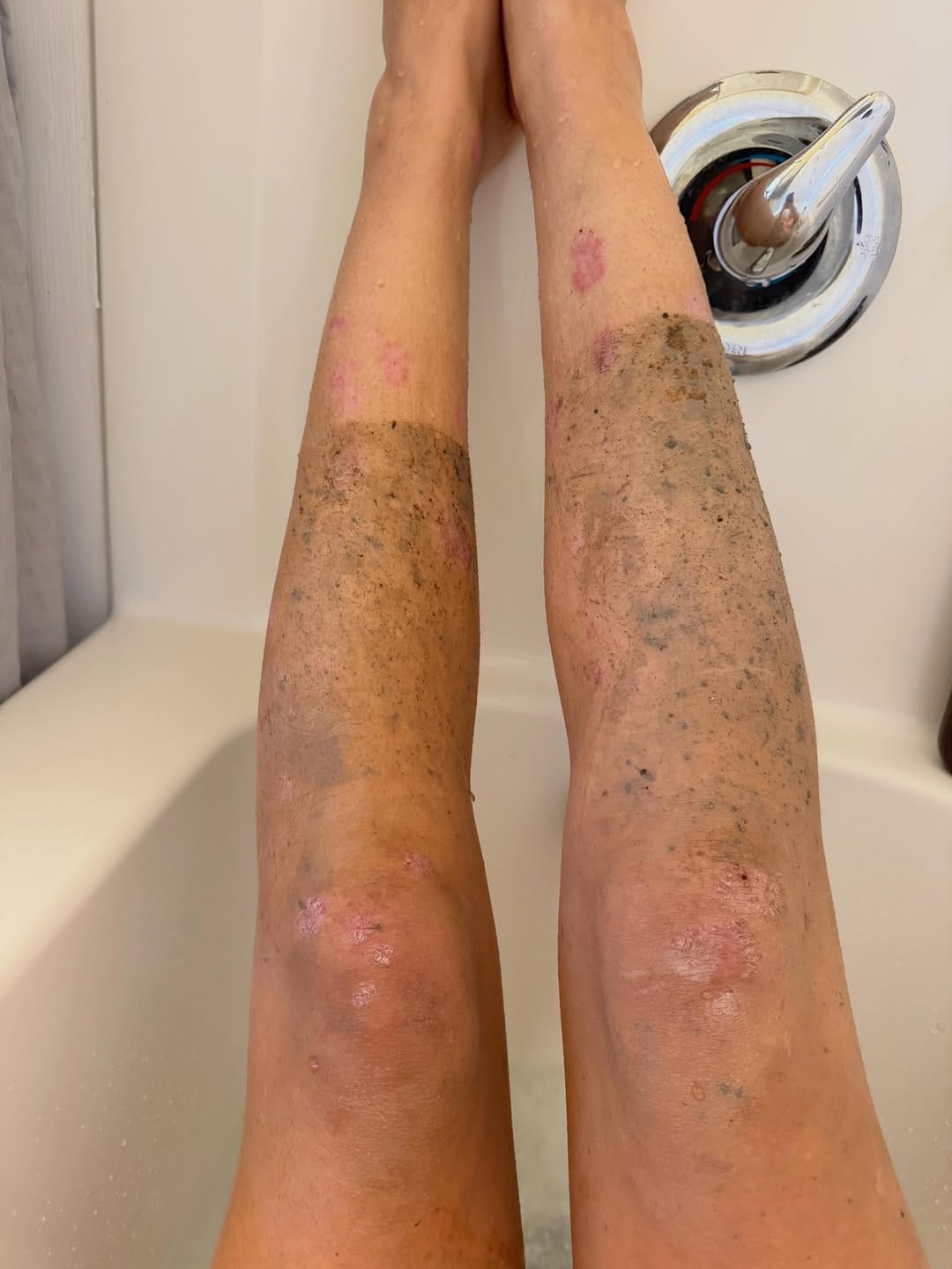 Post 4 by Psoriasis Advocate and Model - Bree Pease on Instagram (carousel)