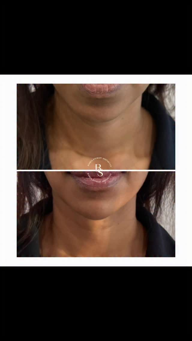 Post 9 by Bianca Stewart Aesthetics on Instagram (video)