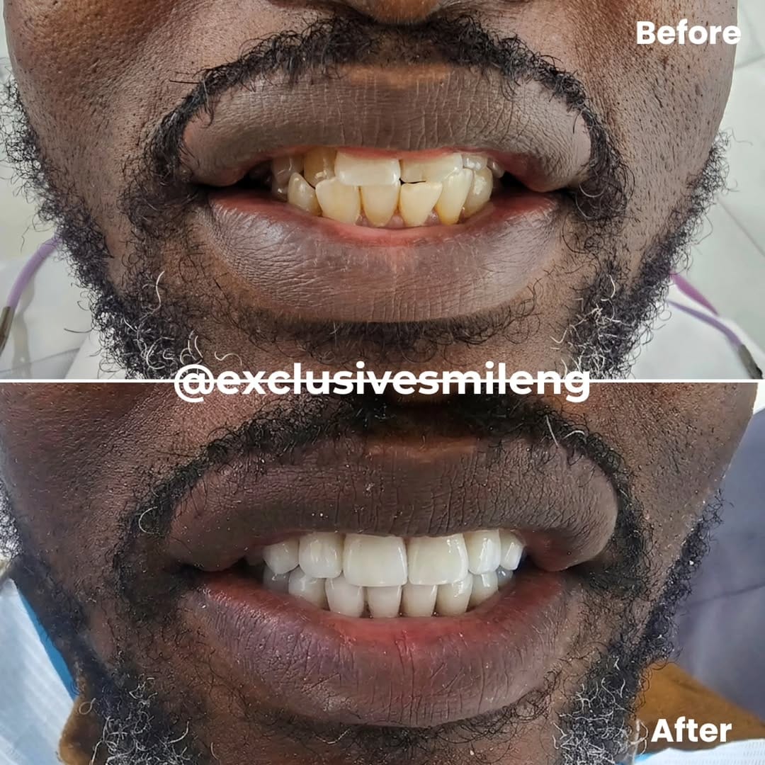 Post 1 by Exclusive Smile | Nigeria's #1 Smile Makeover Clinic on Instagram (image)