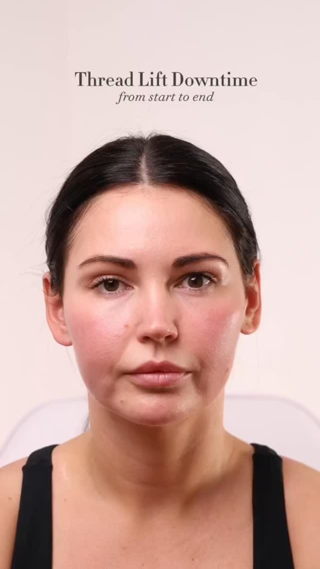 Post 8 by Thread Lift Experts on Instagram (video)