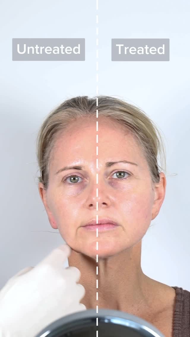 Post 3 by Thread Lift Experts on Instagram (video)
