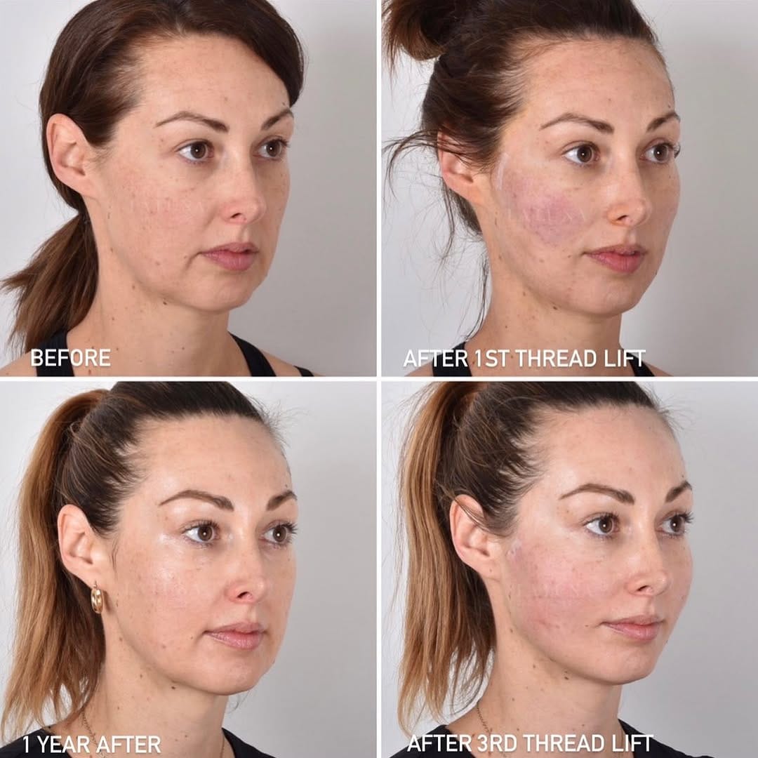 Post 10 by Thread Lift Experts on Instagram (carousel)