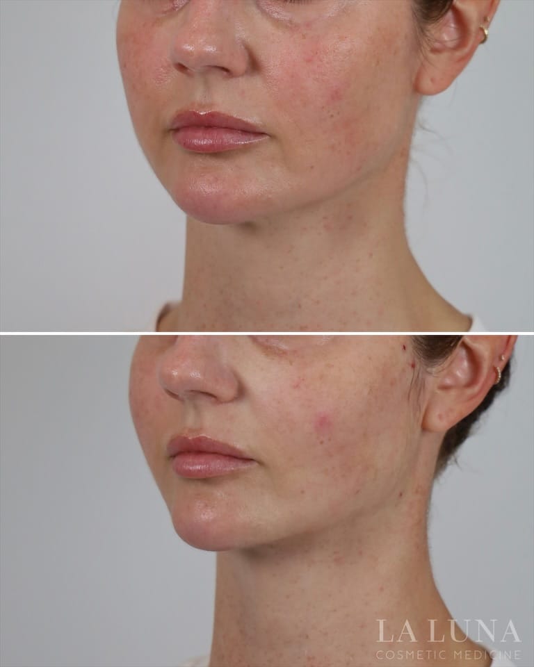 Post 6 by Thread Lift Experts on Instagram (carousel)
