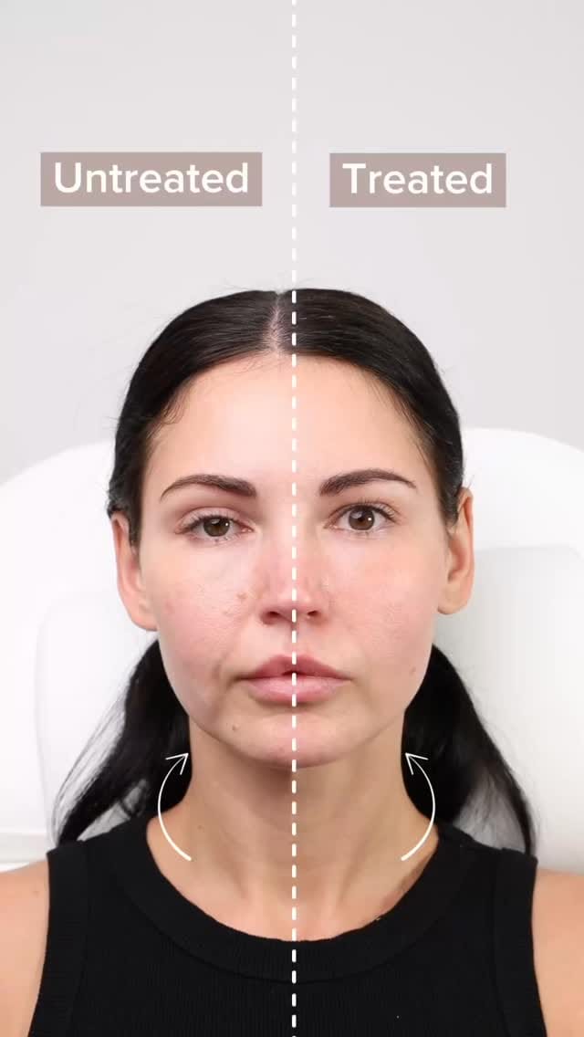 Post 4 by Thread Lift Experts on Instagram (video)