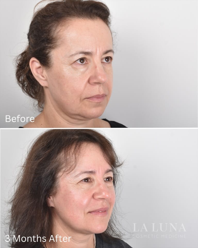 Post 1 by Thread Lift Experts on Instagram (carousel)