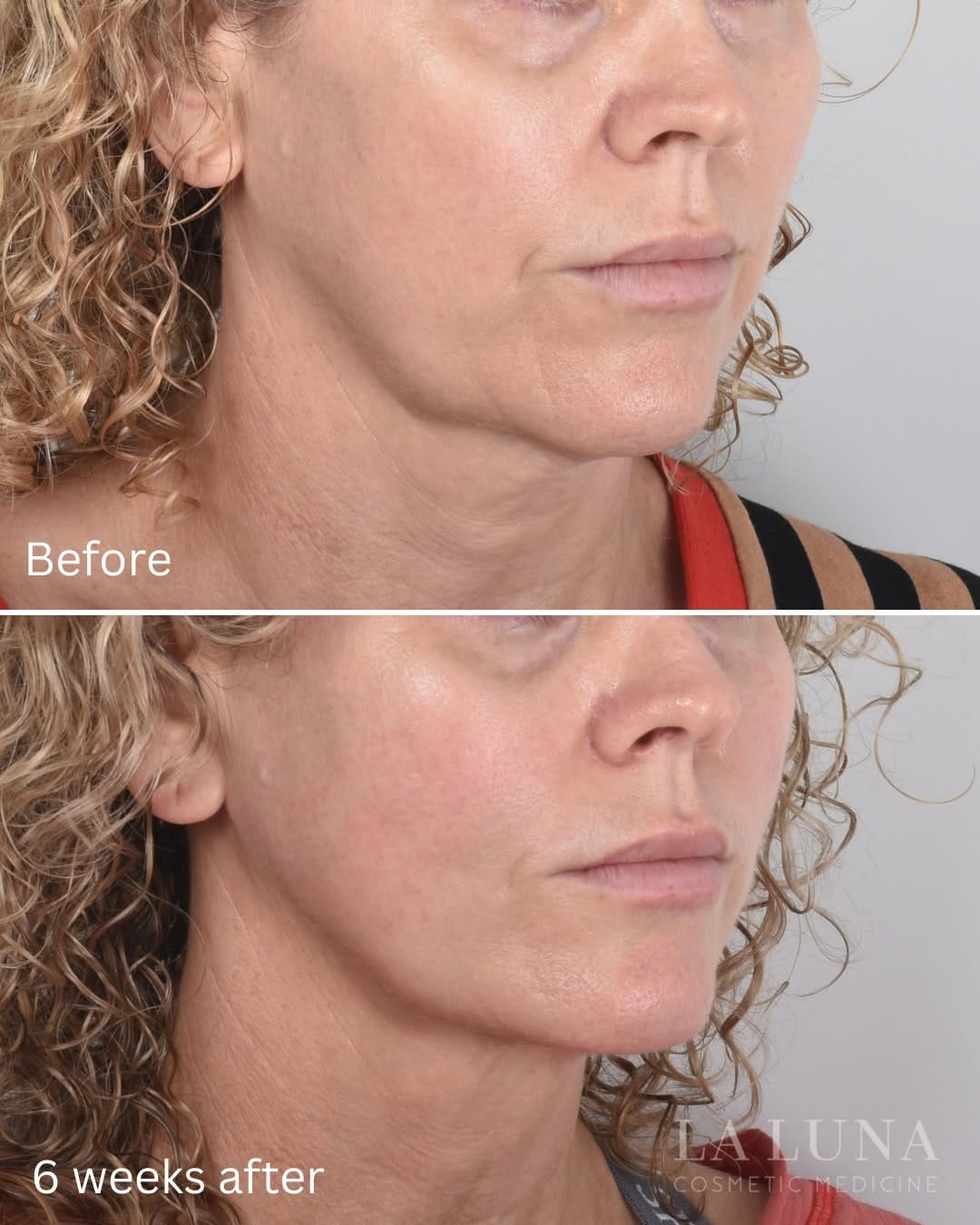Post 5 by Thread Lift Experts on Instagram (carousel)