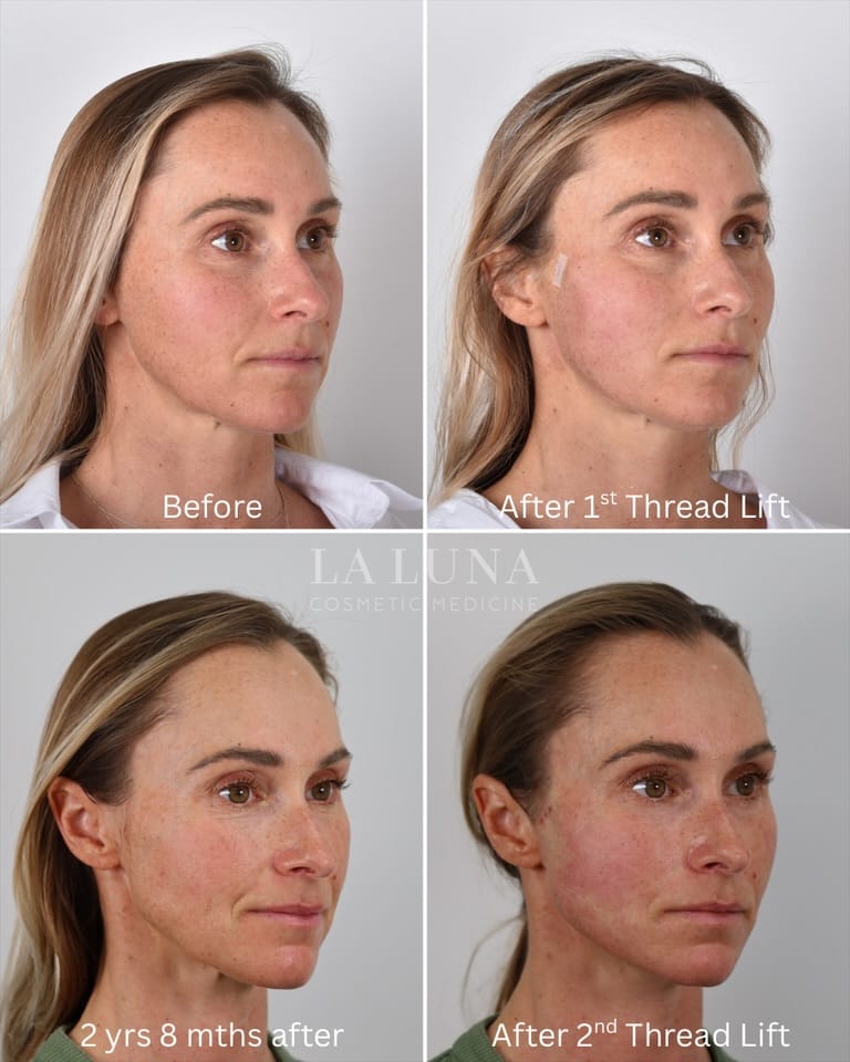 Post 2 by Thread Lift Experts on Instagram (carousel)