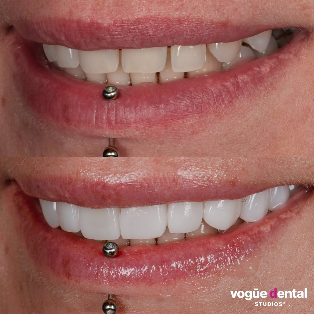 Post 1 by Vogue Dental Studios®️ on Instagram (carousel)