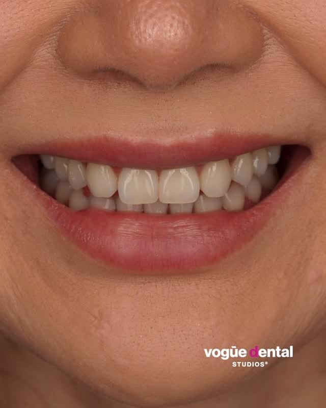 Post 5 by Vogue Dental Studios®️ on Instagram (video)