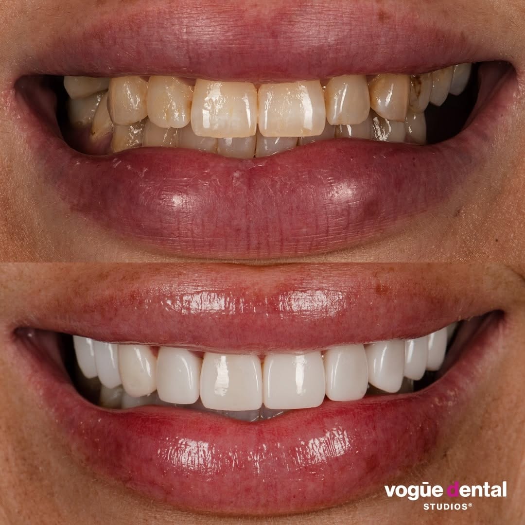 Post 8 by Vogue Dental Studios®️ on Instagram (carousel)
