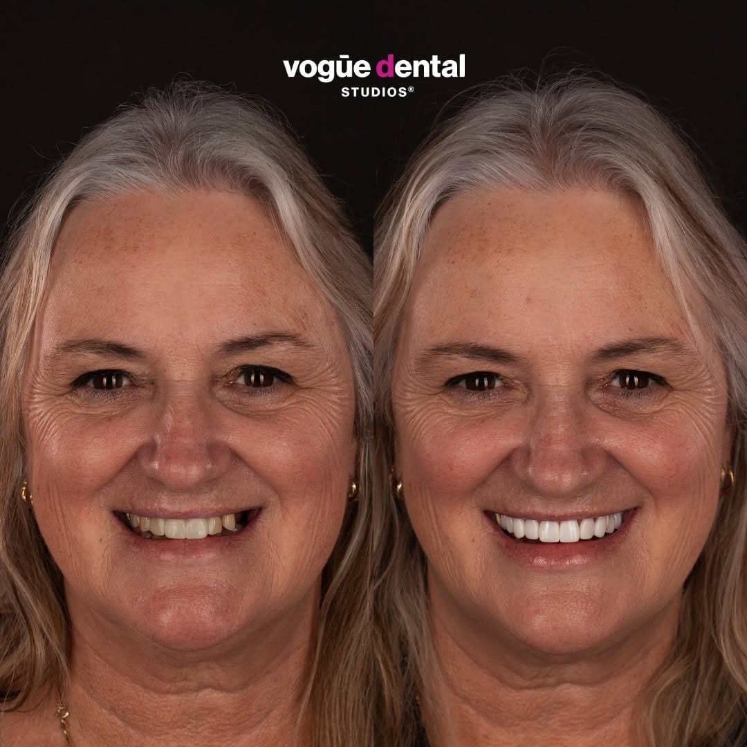 Post 4 by Vogue Dental Studios®️ on Instagram (carousel)