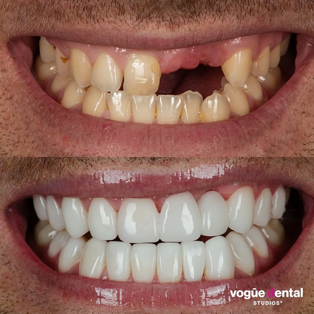 Post 3 by Vogue Dental Studios®️ on Instagram (carousel)