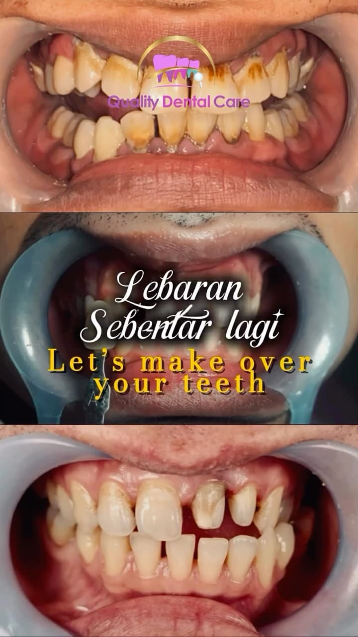 Post 5 by Quality Dental Care on Instagram (video)